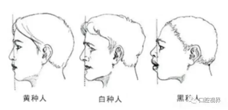 凸嘴龅牙如何变身美人,轻微龅牙如何整形