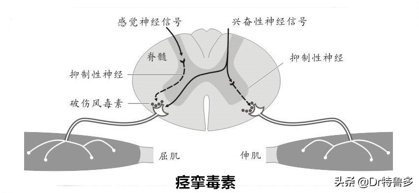 摔水泥地上擦伤会得破伤风吗,骑电车摔跤擦伤要打破伤风吗