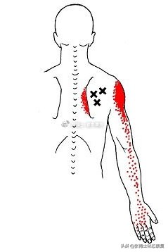 肩胛骨突出矫正的方法,体态矫正脊柱前凸