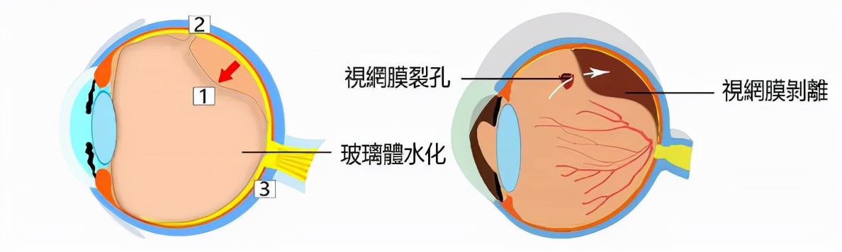 十三岁高度近视能做巩膜加固术吗,后巩膜加固术提高视力