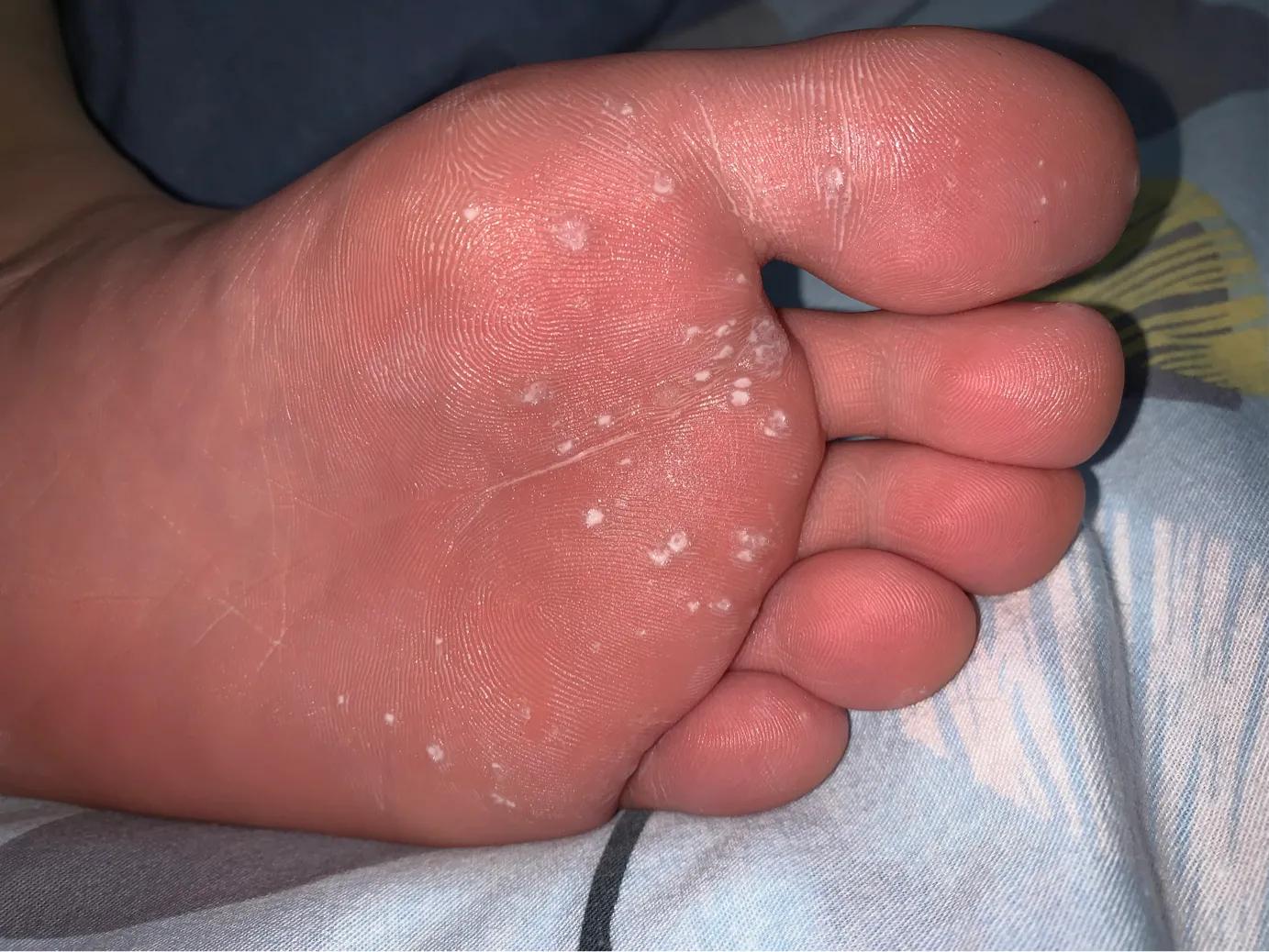 少女脚上长跖疣怎么治疗,10岁女孩长跖疣怎么办