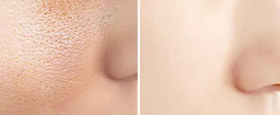 如何根据不同肤质挑选护肤品呢,角质层薄混合肤质用什么护肤品