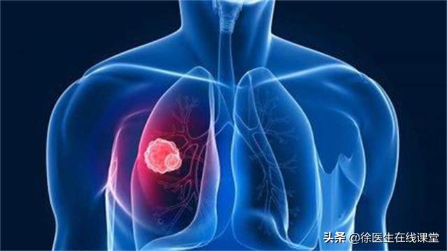 肾病综合征患者得肺癌怎么治疗,肾病综合征与肺癌患者