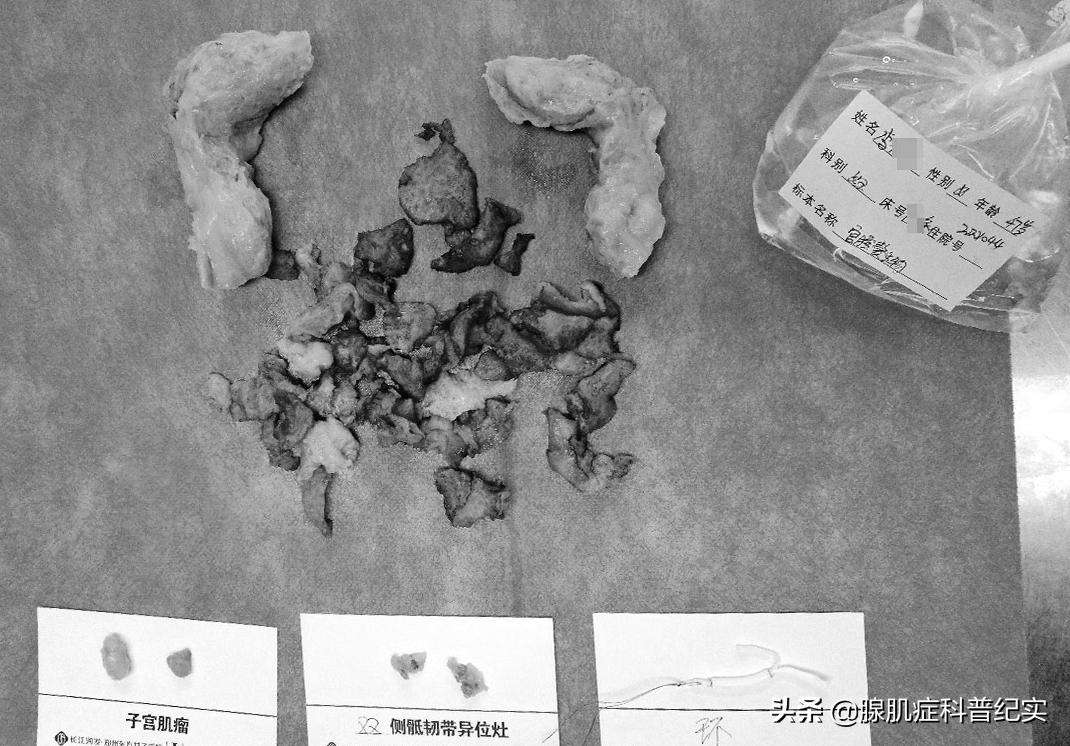 闭经激素针,闭经激素针是什么样的