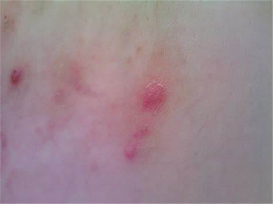 湿疹怎么治好得快婴儿湿疹,湿疹反反复复如何护理