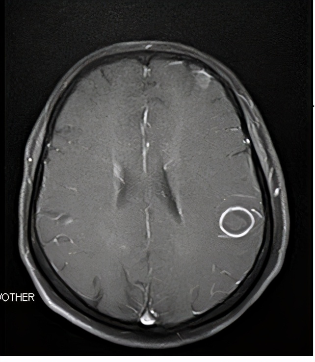 一位肺癌晚期患者活过11年的秘密,极晚期肺癌