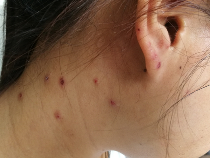 光过敏/多形性日光疹