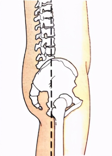 腰变直要怎么调理过来,腰变直怎么办教你一招