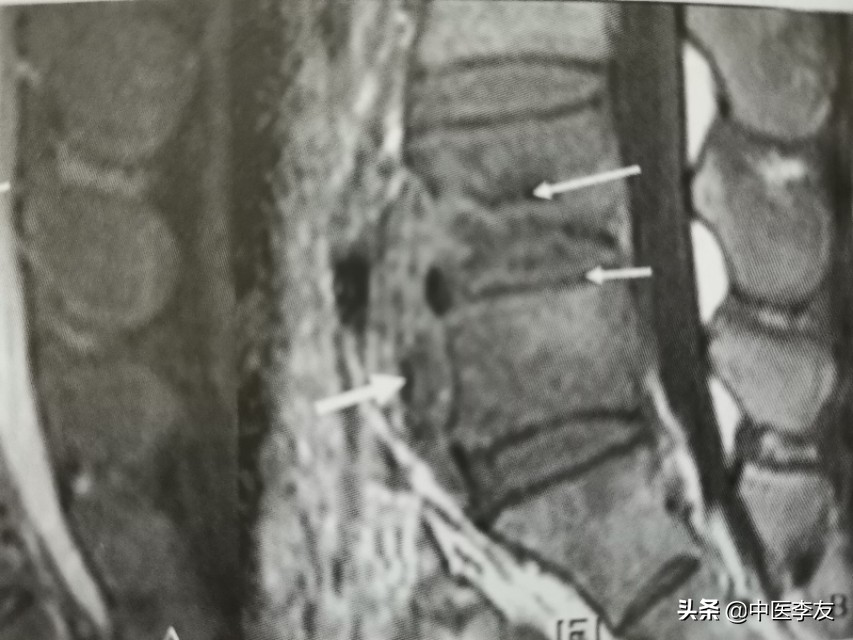 腰椎骨结核治愈后出现腰疼,脊柱结核腰痛怎么治