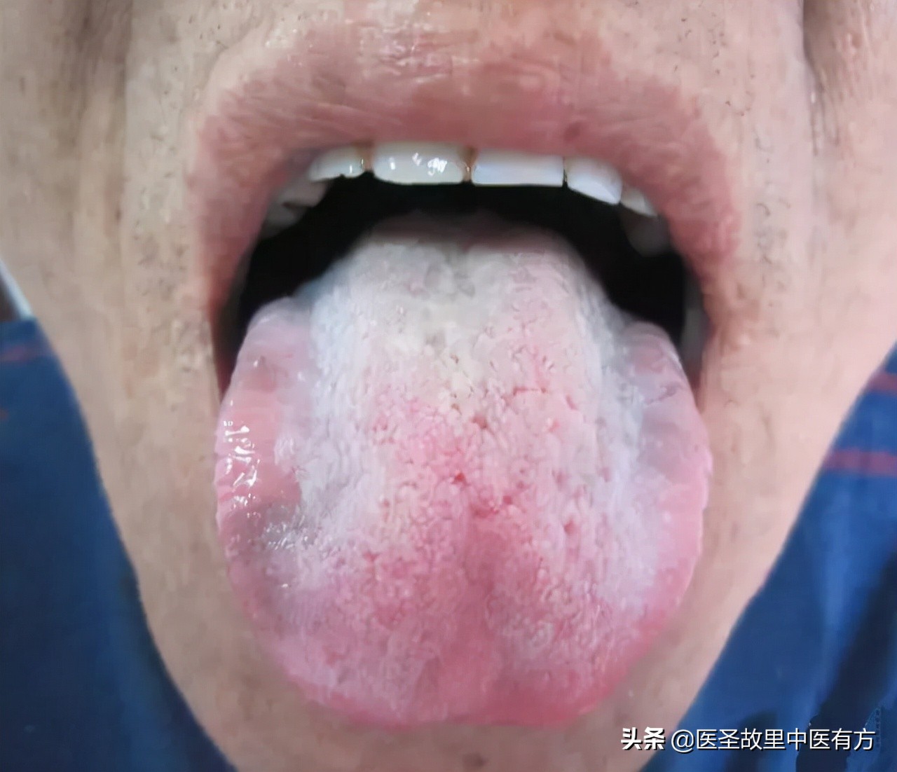 自汗盗汗有什么妙招,自汗盗汗解决方法