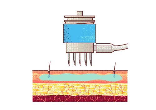 补水美白抗皱水光针,美白紧致提亮肤色的水光针