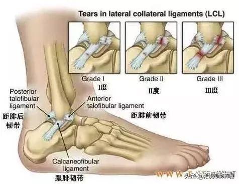 踝关节不稳康复训练,慢性踝关节不稳的运动康复修复