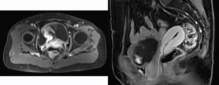 sbrt肿瘤放疗副作用有哪些,复发宫颈癌常用化疗方案