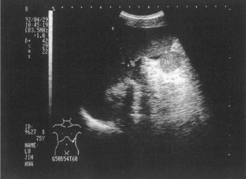 妇产超声科检查什么,妇产科检查超声一般是有什么问题