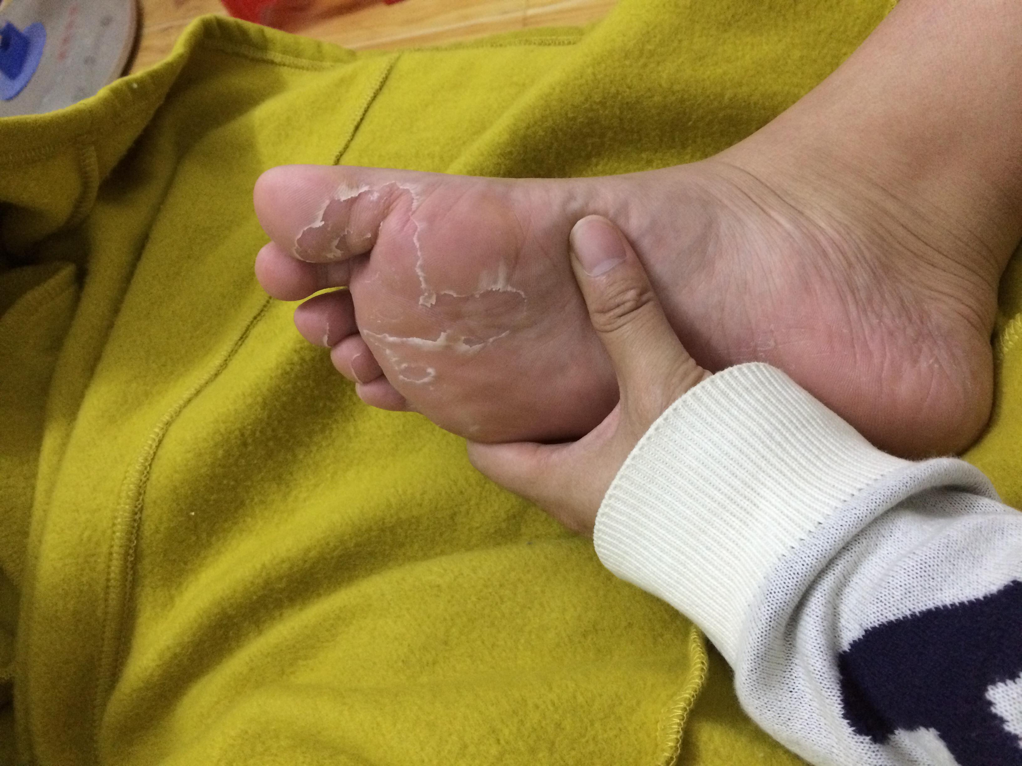 脚脱皮治不好？掌握这个方法，不用洗也不用晒的脚臭星人福音