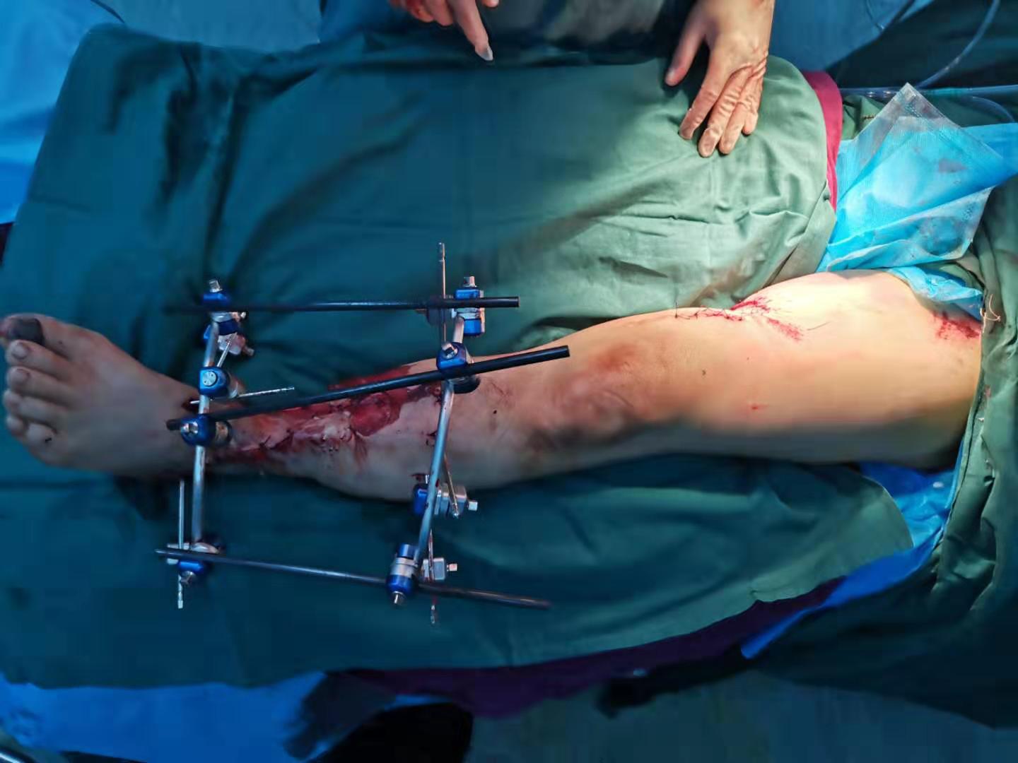 沈医附属中心医院7小时手术为他“留”左脚，这种危险身边还有！