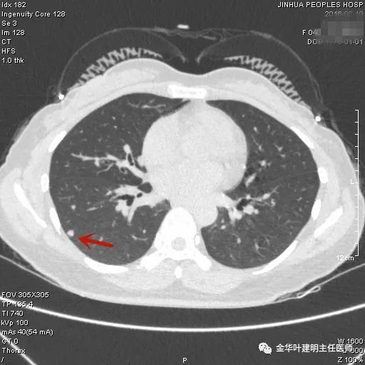 叶建明谈实性结节,叶建明肺实性良性结节会变癌症吗