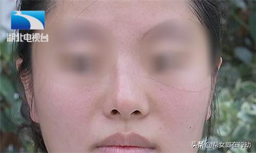孕妈花高价垫鼻梁，不料术后歪成“蛇精”，医院：最多退4000