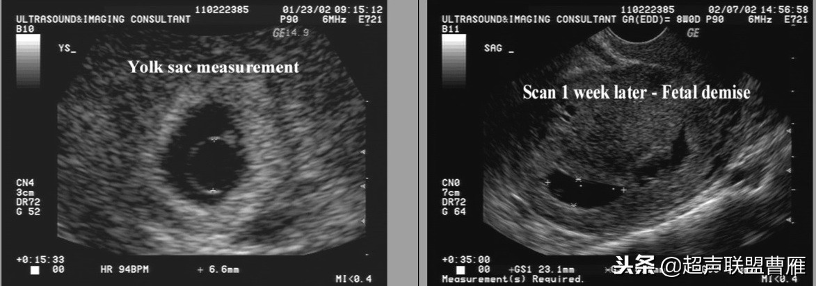内见卵黄囊,卵黄囊肿瘤