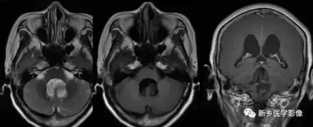 脑室为什么会扩张,脑室为什么会变小