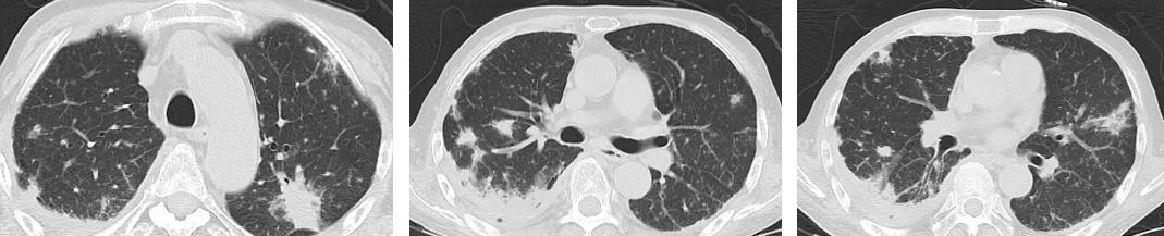 肺结核防控诊疗方案,成功治疗肺结核病的关键