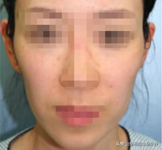 脸部凹陷怎么变饱满面部填充,脸凹陷全脸填充会不好看吗