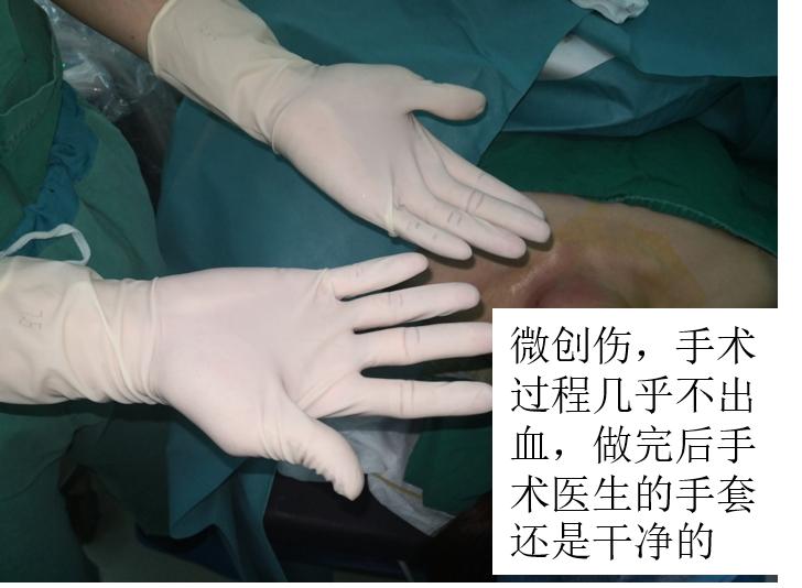 甲状腺结节微创消融手术,甲状腺结节微创消融医保