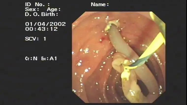 现在还存在蛔虫病吗,为何现在没人感染蛔虫了