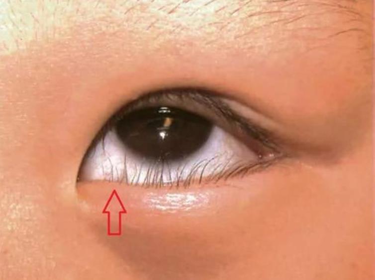 孩子总是揉眼睛用什么药,孩子总是揉眼睛眼疼怎么办