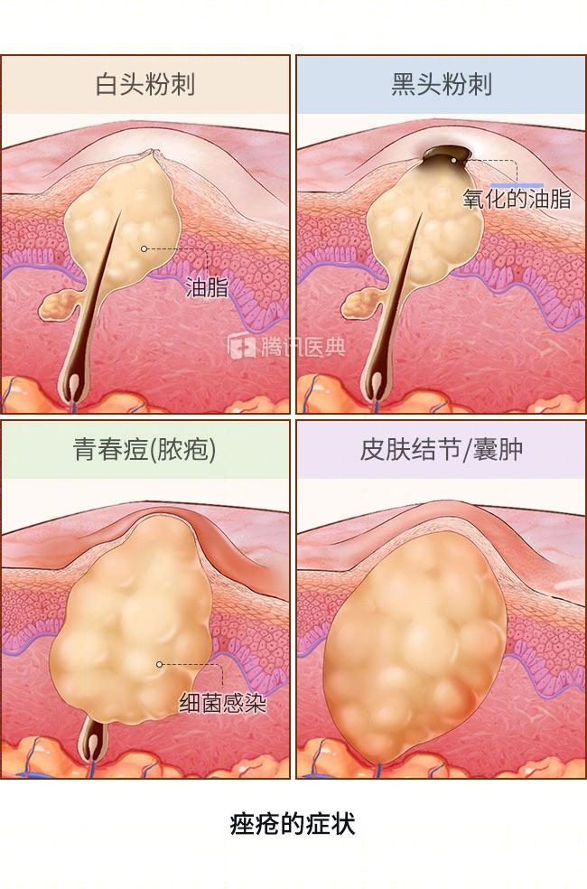 比较靠谱的去黑头方法,实测有效的去黑头方法