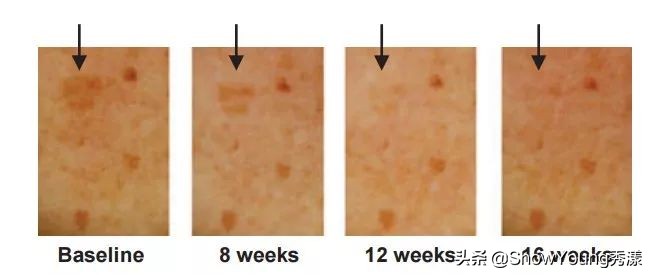 要肌肤像剥了壳的鸡蛋？你对斑了解多少？