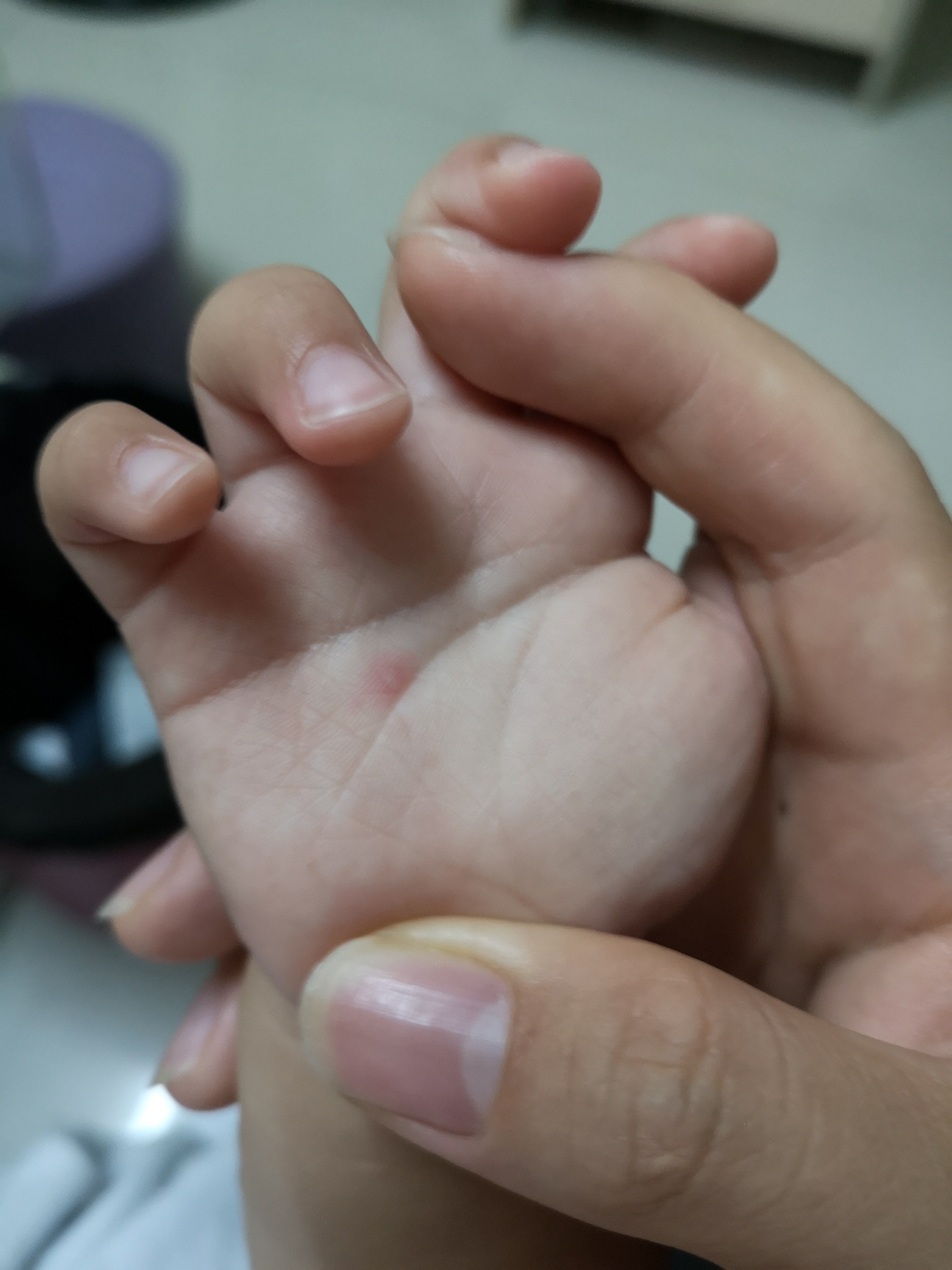 手足口病毒高发期,手足口高发期温馨提示