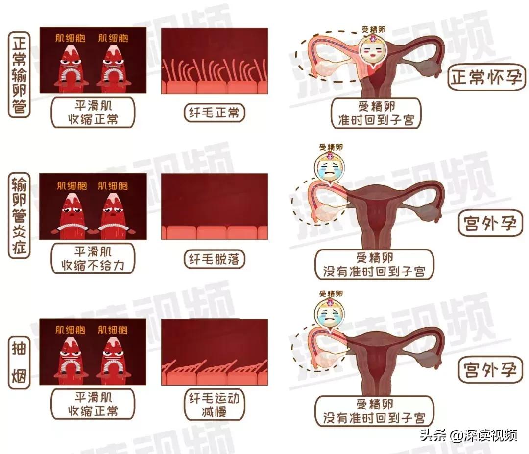 宫外孕和男性不良习惯有关系吗,这些习惯会导致不孕