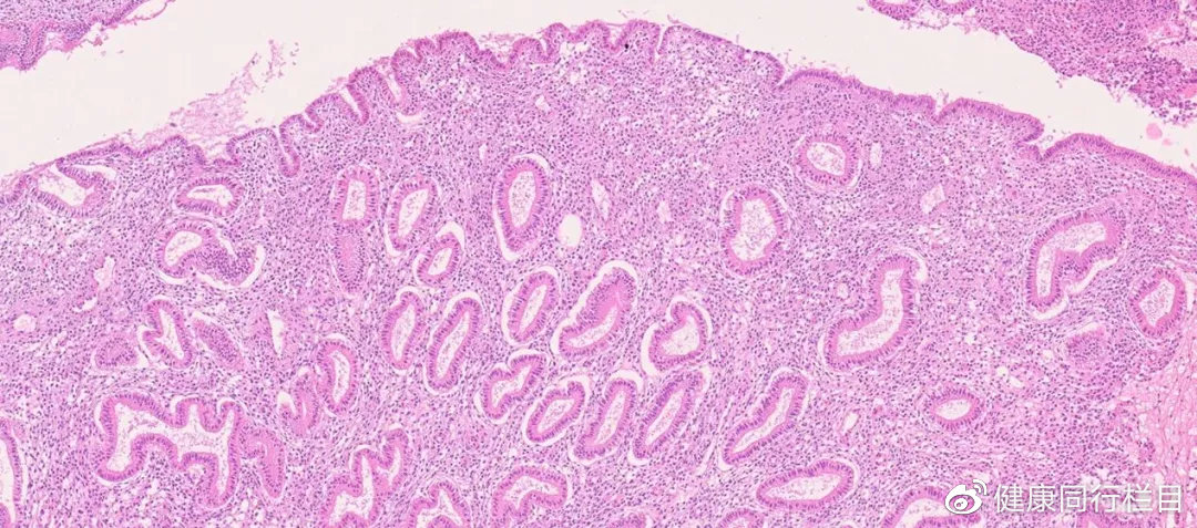 子宫内膜癌的防癌筛查,子宫内膜癌预防与筛查