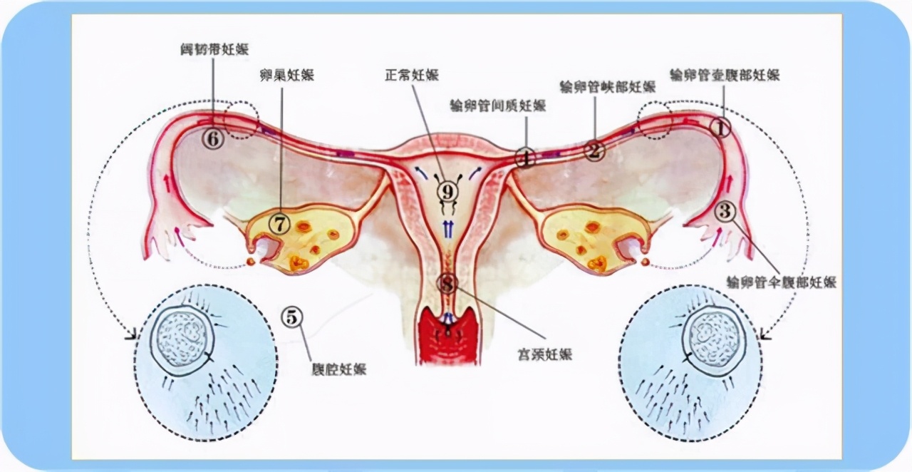宫外孕切除输卵管会有什么后遗症,宫外孕为什么医生建议输卵管切除