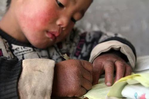 孩子脸冻成高原红怎么办,小婴儿高原红