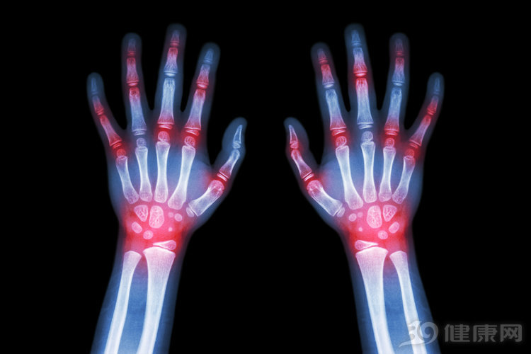 痛风有没有最好的治疗方法,痛风难忍时有什么缓解方法