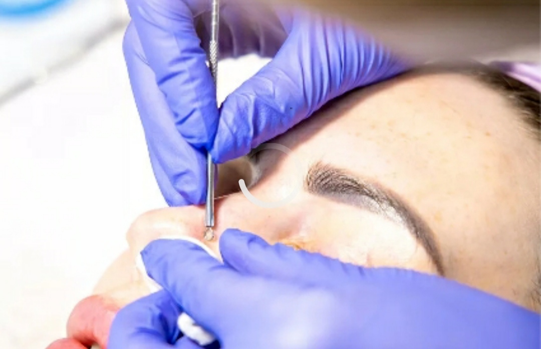 冬天皮肤干但有黑头闭口痘痘,皮肤又油又干有黑头毛孔大