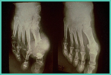 痛风石怎么溶解排出能痊愈,痛风石破溃后能自行愈合吗