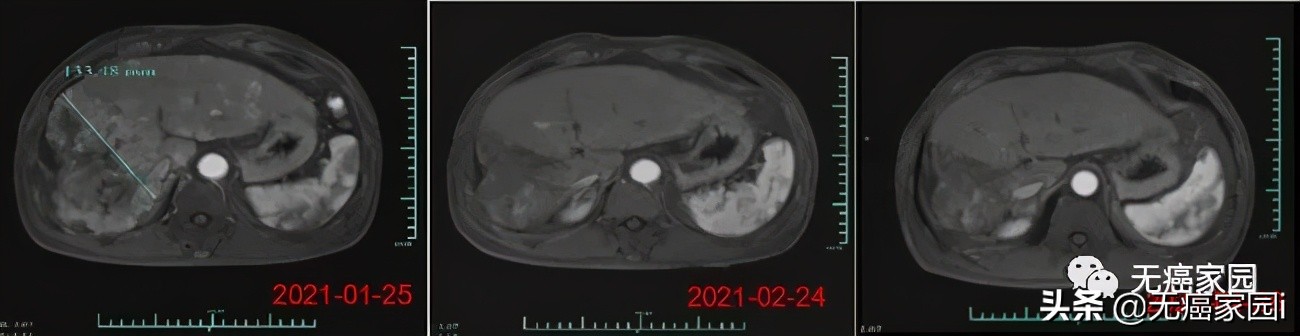 中国cart细胞疗法上市,car-t新药进展
