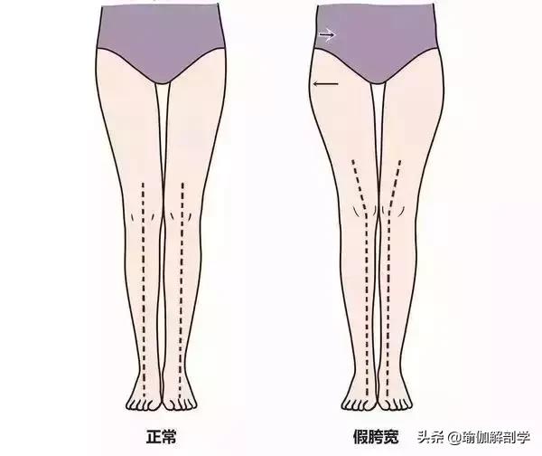 瑜伽可以矫正假胯宽吗,瑜伽改善假胯宽全套