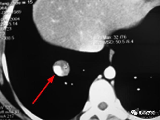肺肉芽肿影像学表现ppt,肺韦格纳肉芽肿影像学表现