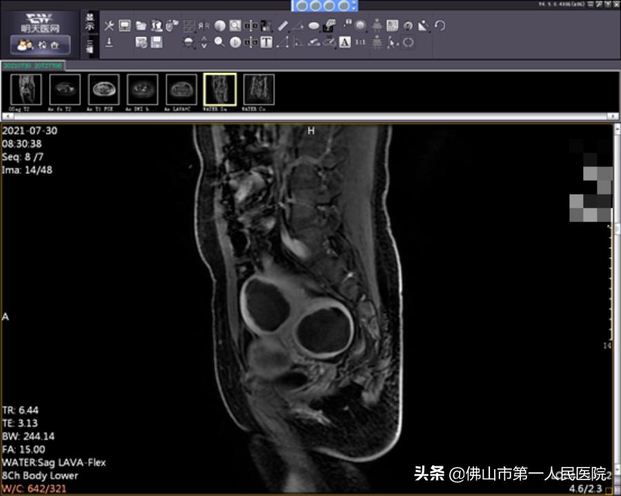 这把“刀”能隔山打“牛”,呵护子宫,带来好“孕”