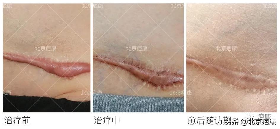 手术伤疤涂什么药膏,外伤肥厚性疤痕用什么药膏