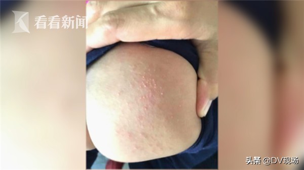 婴儿屁股起红色硬疹子怎么回事,新生儿用纸尿裤屁股上有红点