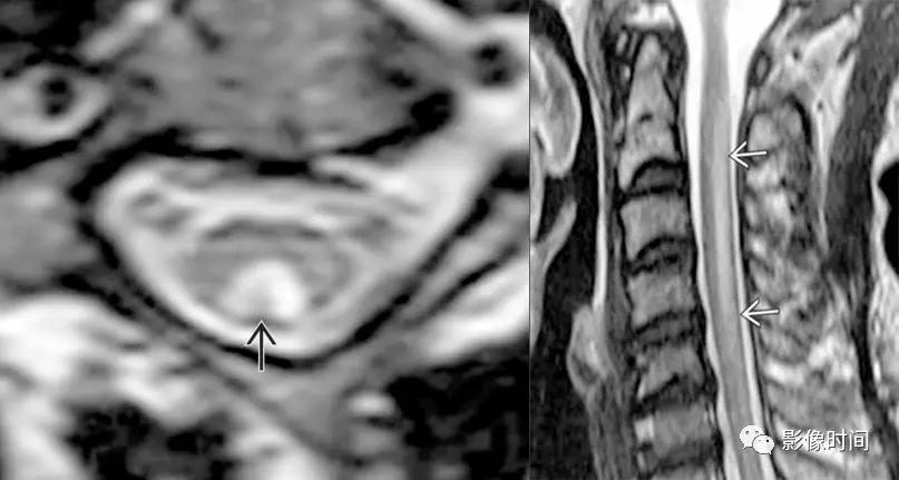 脊髓病变案例图文问诊,脊髓病变视频