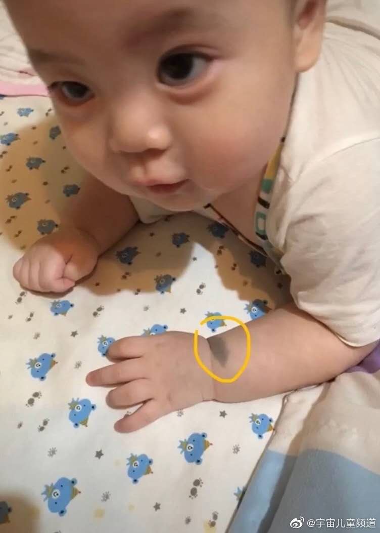 狗狗胎记和孩子一样,狗狗有胎记孩子也有胎记