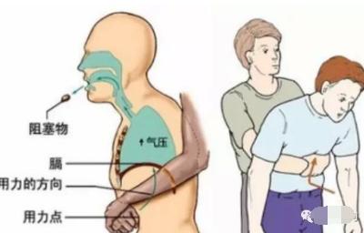 宝宝吃蓝莓卡喉父亲施救后续,小孩吞弹珠抢救视频