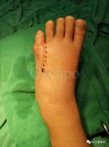 健康学堂丨多指（趾）未必多福！及早就诊才是最佳选择