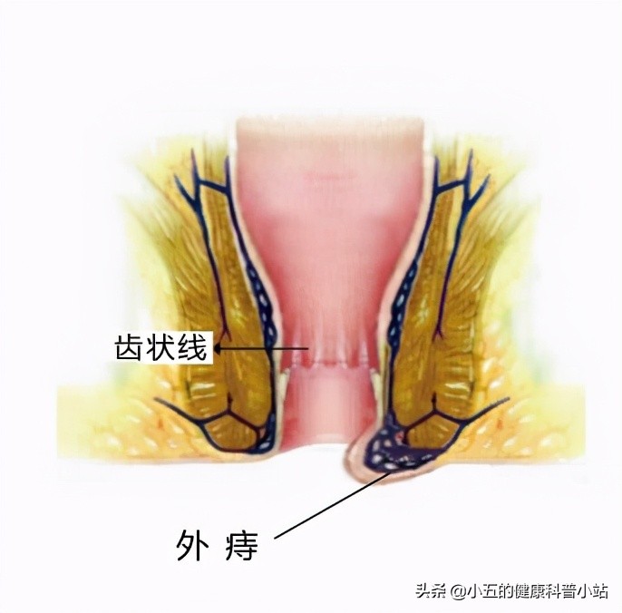得了痔疮的人平时应该如何护理?除药物和手术治疗外还需注意6点